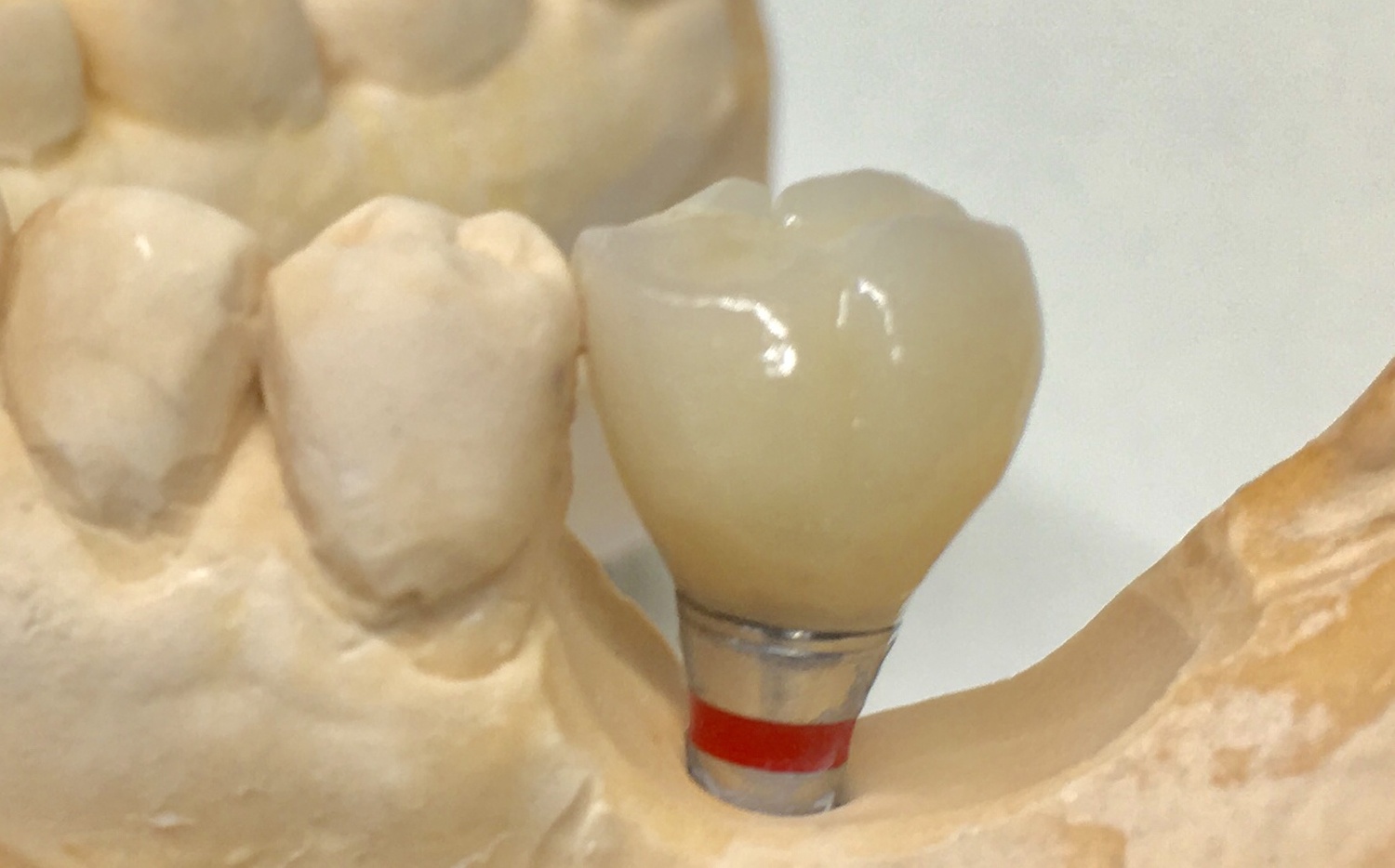 Prothèse implanto-portée